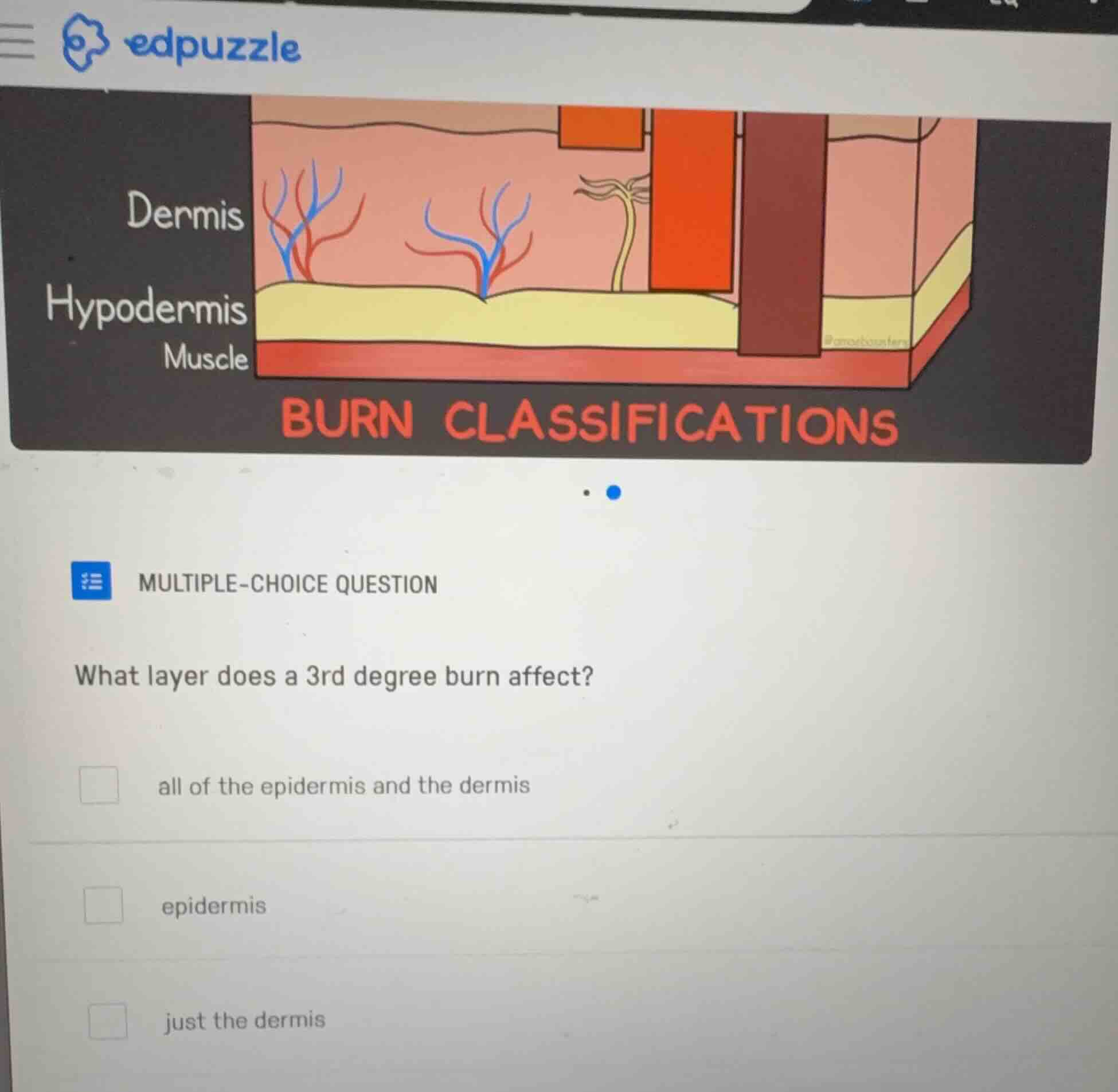 multiple-choice question what layer does a 3rd degree burn affect? all …