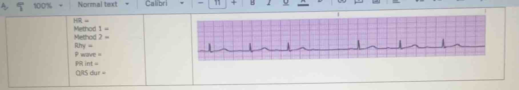 hr = method 1 = method 2 = rhy = p wave = pr int = qrs dur =