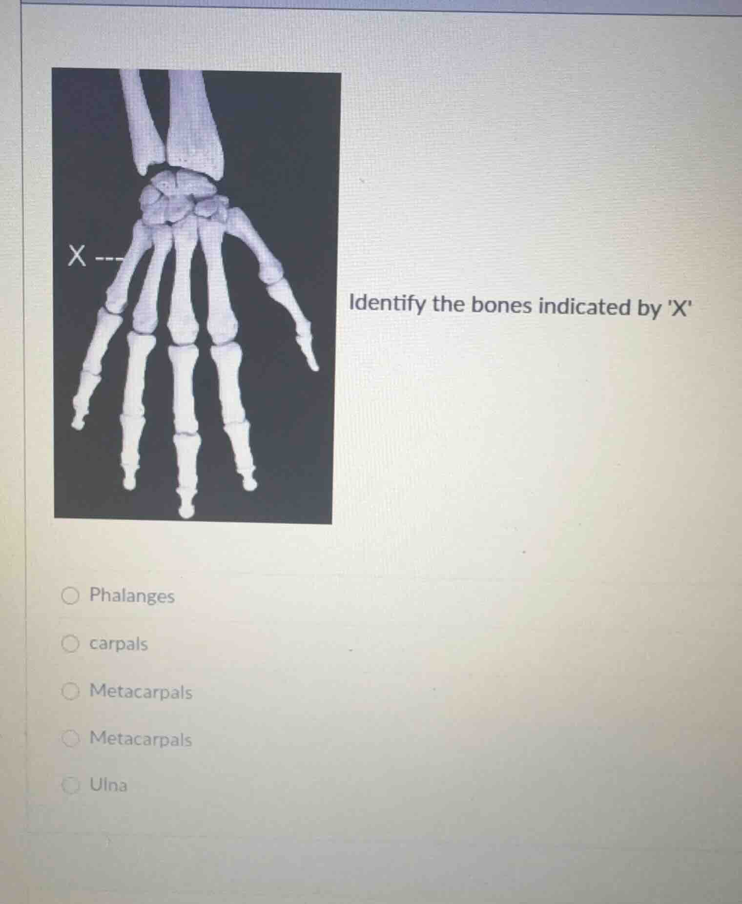identify the bones indicated by x phalanges carpals metacarpals metacar…